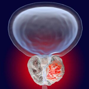 Enzalutamide nel K prostata