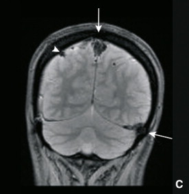 DOAC vs warfarin nella trombosi cerebrale