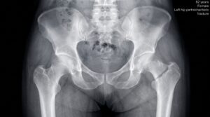 Aderenza a terapia di vitamina D in medicina generale